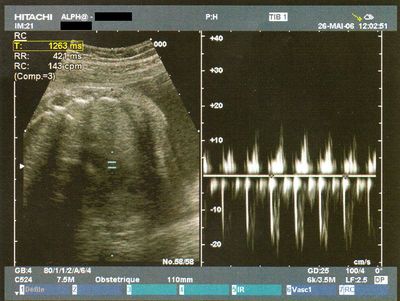 Rythme cardiaque foetal