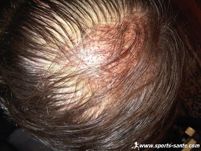 Image de FUE sur le crâne et tourbillon