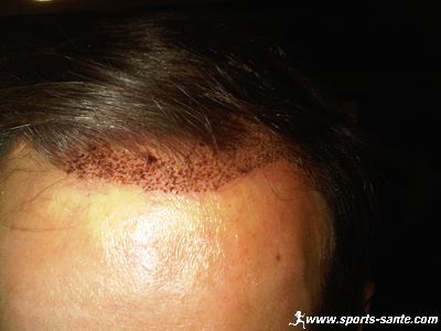 Photo de résultats de micro greffe de cheveux par technique F.U.E