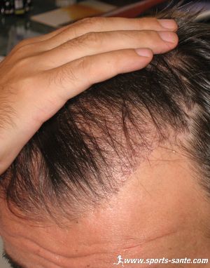 Photo micro greffe cheveux