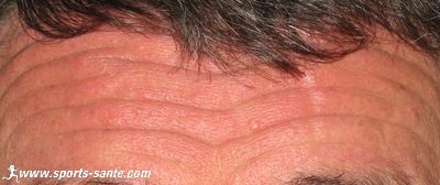 Traitement des rides par injection de toxine botulique